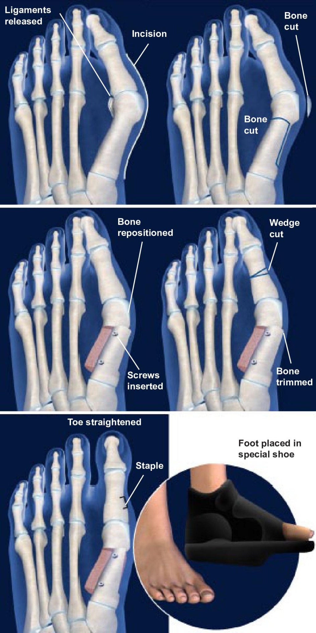 Picture of: Bunion Correction with Scarf and Akin Osteotomy – Orthoriverside